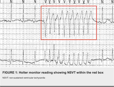 Figure 1 From Non Sustained Ventricular Tachycardia As A Presentation Of Arrhythmogenic Right