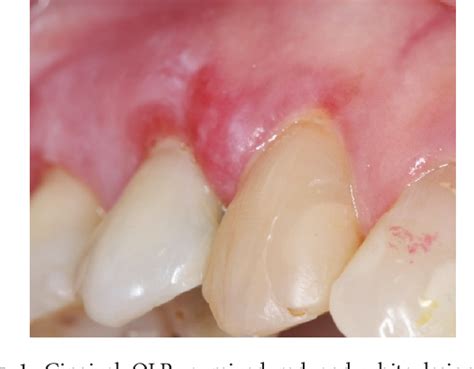 Figure From The Gingival Oral Lichen Planus A Periodontal Oral