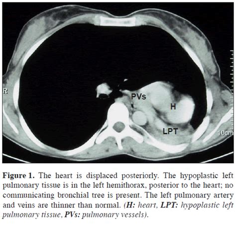 Unilateral pulmonary hypoplasia