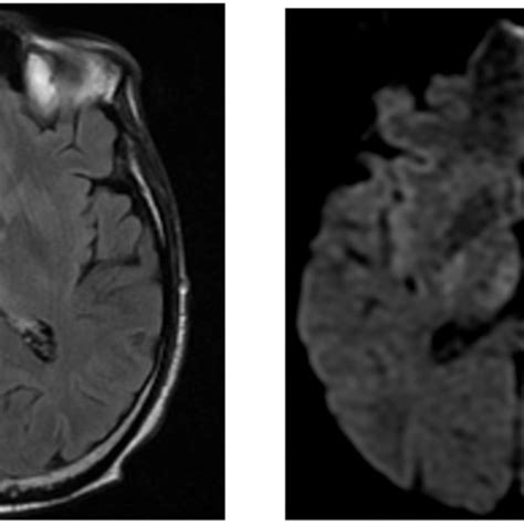 Cerebral MRI images showing hyperintense signal of the periaqueductal ...