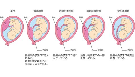 30週 前置胎盤の可能性 パニック障害専門の漢方薬局と通販 自律神経失調症・不安感はおまかせ