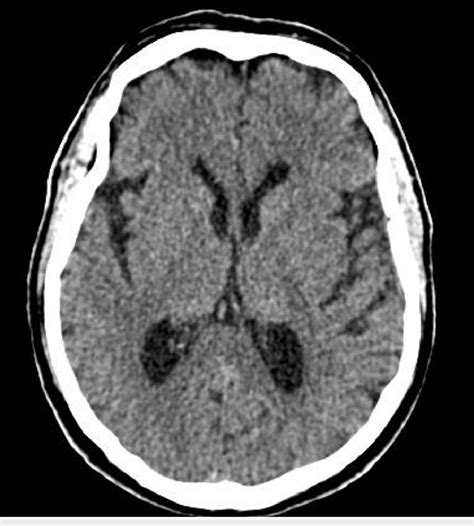 Computerized Tomography Ct Of The Head Showing Moderate Parenchymal Download Scientific