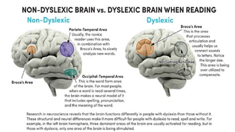 A Comparison Of Key Brain Areas In Dyslexics And Non Dyslexics