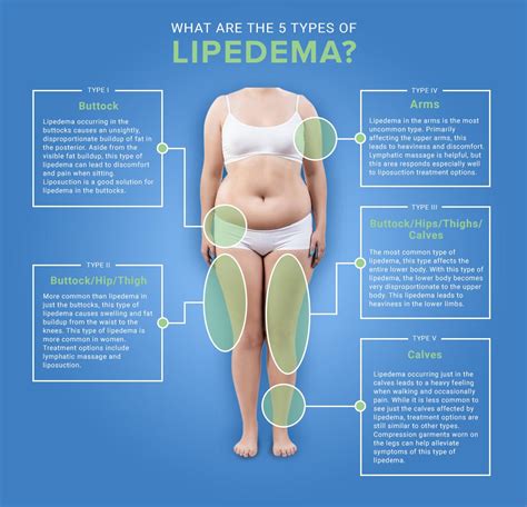 Learn About Stages and Types of Lipedema | Lipedema.net