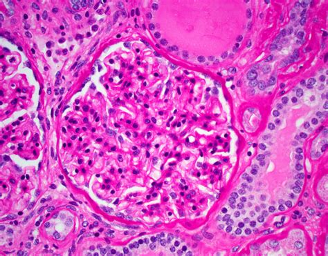 Nephrotic Syndrome Histology | The Best Porn Website