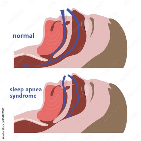 Sleep Apnea Respiratory Tract Diagram Medical Poster Vector Illustration Stock Vector Adobe