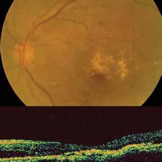 (PDF) Treatment of hard macular exudates in diabetic retinopathy