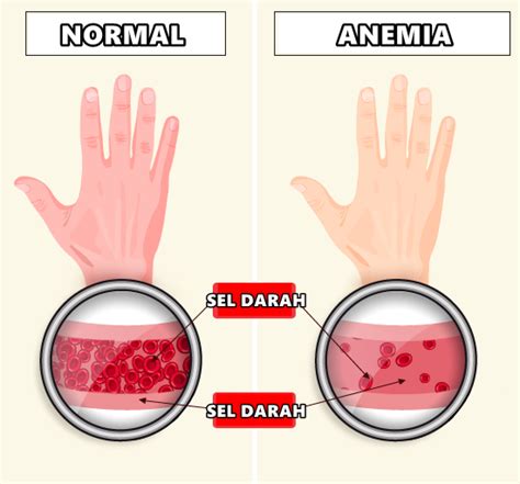 Anemia Penyakit Apa Homecare24