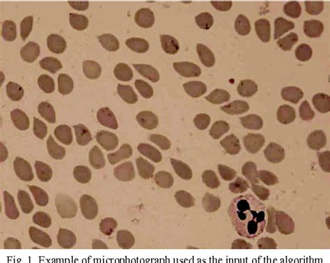 Figure 1 From Automated Detection Of Southeast Asian Ovalocytosis Sao