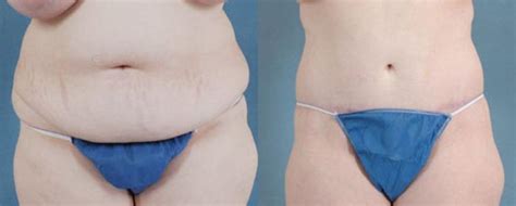 Extended Tummy Tuck Abdominoplasty Before And After Photo Gallery