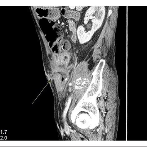 Sagittal Reconstruction Of CT Abdomen And Pelvis With Oral And IV