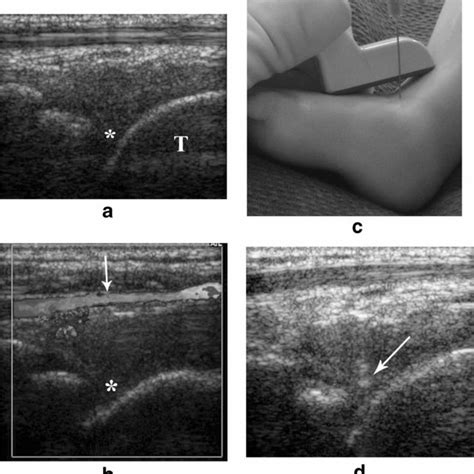 Pdf Technical Tips To Perform Safe And Effective Ultrasound Guided