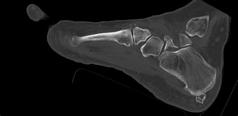 Anterior Calcaneal Process Fracture Radiopaedia C Nc