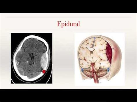 Overview Rsna Intracranial Haemorrhage Detection Youtube