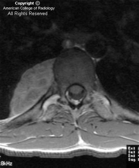 Neuroradiology On the Net: Malignant peripheral nerve sheath tumor ...