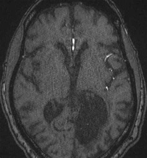 Acute Right Mca Infarct Neuro Mr Case Studies Ctisus Ct Scanning