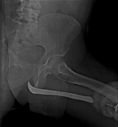 Venous Intravasation Retrograde Urethrography Radiology Case