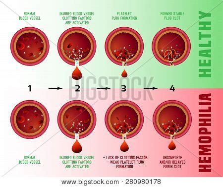 Hemophilia Blood Vector & Photo (Free Trial) | Bigstock