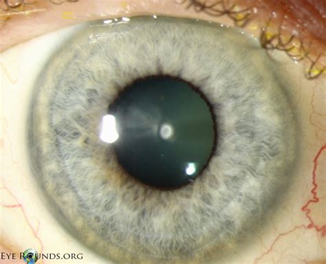 Atlas Entry - Anterior polar cataract