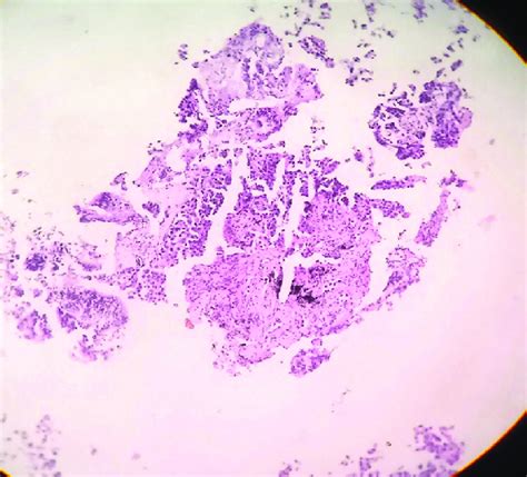 Bronchoscopy biopsy histopathology (×10) | Download Scientific Diagram