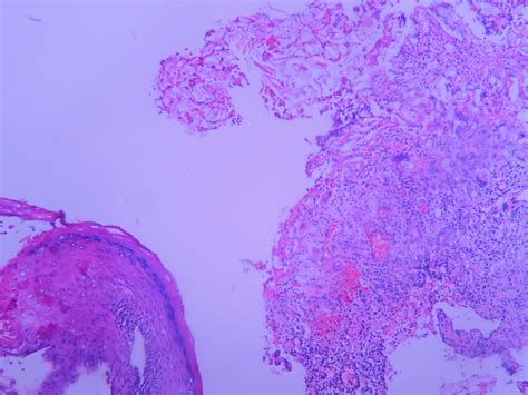 Cholesteatoma Histopathologyguru