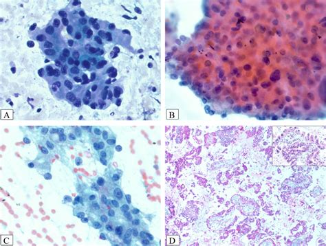 Cytopathologic Diagnosis Of Oncocytic Type Intraductal Papillary Mucinous Neoplasm Criteria And