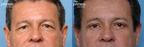 Blepharoplasty Before And After Pictures Case 12 Orlando Florida