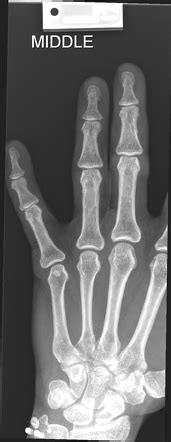 Middle phalanx fracture | Radiology Case | Radiopaedia.org