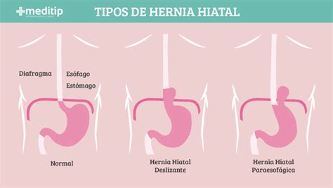 Hernia hiatal tipos causas síntomas y tratamiento