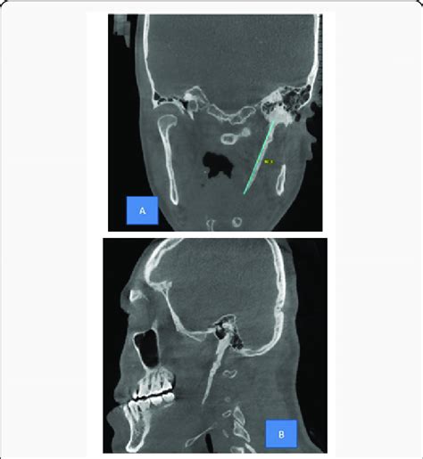 CBCT revealing elongation of left styloid process, in various sections.... | Download Scientific ...