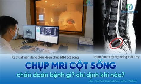 Chụp Mri Cột Sống Là Gì Vai Trò Của Chụp Cộng Hưởng Từ Cột Sống