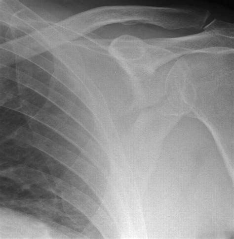 Low Energy Bilateral Scapular Fractures Emergency Medicine Journal