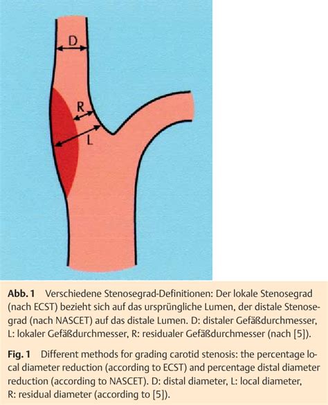 Figure 1 From Ultraschallkriterien Zur Graduierung Von Stenosen Der A