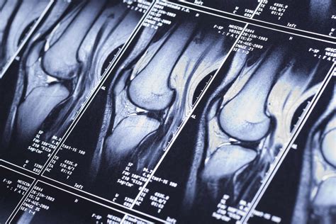 Understanding Knee MRI Images • American Health Imaging