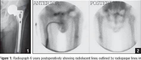 Figure 1 From Teriparatide Rh 1 34 Pth Improved Osteointegration Of A Hemiarthroplasty With