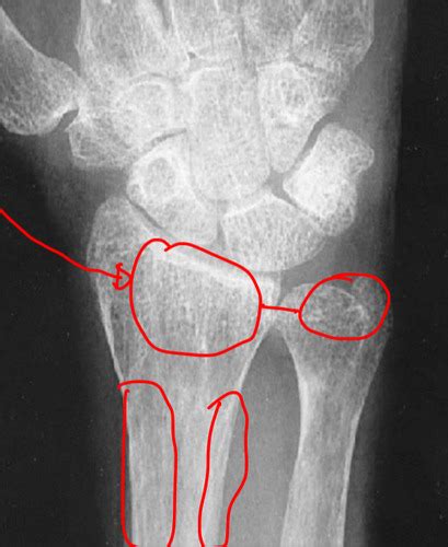 Osteomalacia And Rickets Pictures Flashcards Quizlet