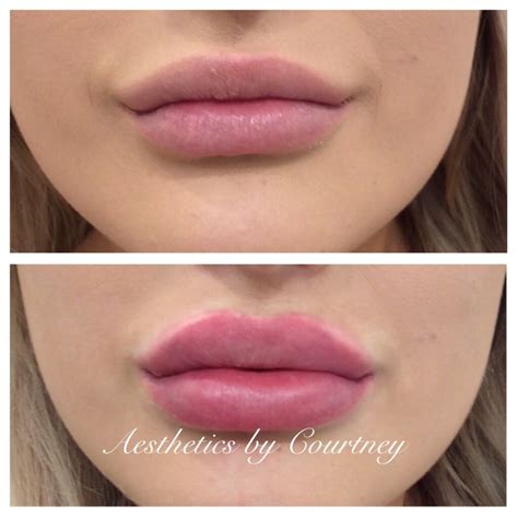 αυυυвreyтαтe ☾♡ Botox Lips Lip Fillers Lip Augmentation