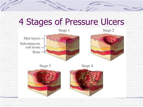 PPT Pressure Ulcers Bed Sores PowerPoint Presentation Free