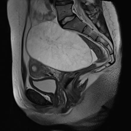 Ovarian Torsion Radiology Case Radiopaedia Org