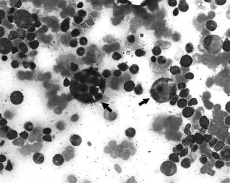 Bone Marrow Aspiration Smear Reveals Activated Macrophages With