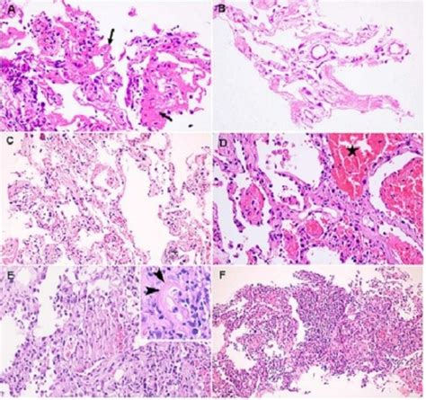 Histopathological Observations In COVID 19 A Systematic Review