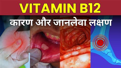 Vitamin B Deficiency Symptoms Vitamin B Ki Kami Ke Karan Aur