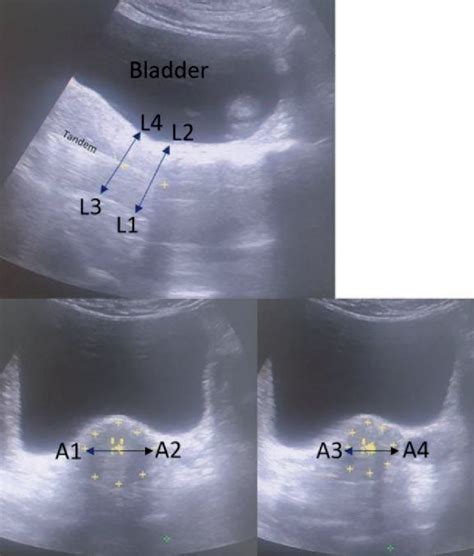 Figure 5 From Ultrasound Guided Brachytherapy For Cervical Cancer A Tool For Quality