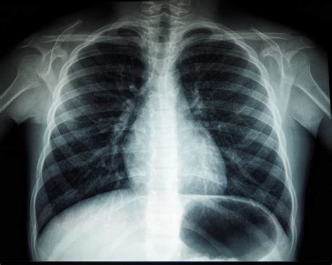 Diagnosing Pneumonia From X Ray Images Using Convolutional Neural Network By Tony Tsoi