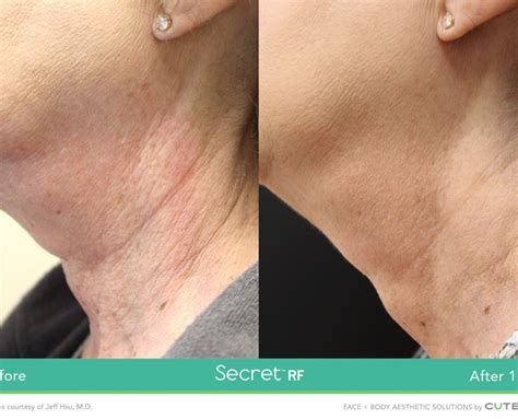 Secret RF Radio Frequency Microneedling Image Perfect Laser