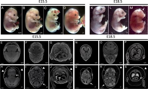 Mutations In SMG9 Encoding An Essential Component Of Nonsense Mediated