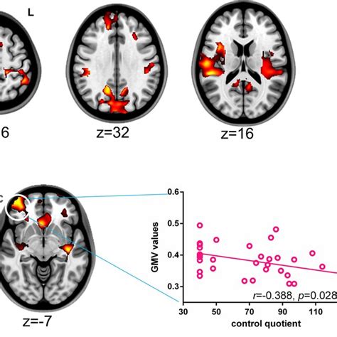 Gray Matter Alterations In Patients With Rolandic Epilepsy Group