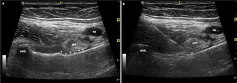 Pericapsular Nerve Group Block In Hip Surgery A Narrative Review