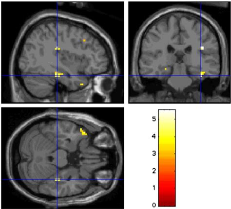 Parahippocampal Gyrus