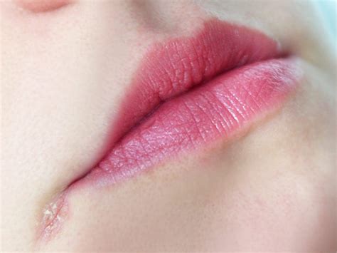 Corner Of Lips Sore Treatment